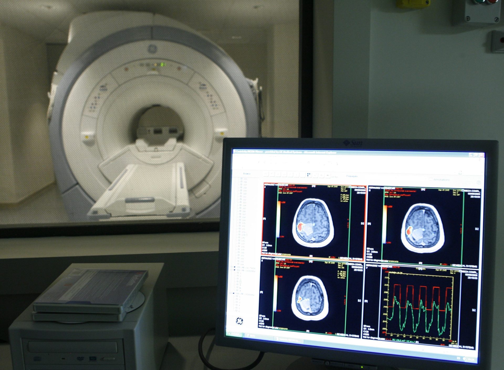 Vista de un escáner en un centro de tratamiento de Alzheimer. Investigadores internacionales han identificado dos nuevos genes que aumentan el riesgo de desarrollar la enfermedad.