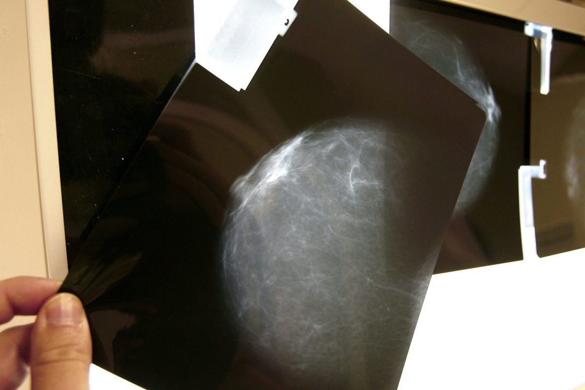 Una mamografía. Descubierto un farmaco que evita metástais en cánceres infantiles y de mama