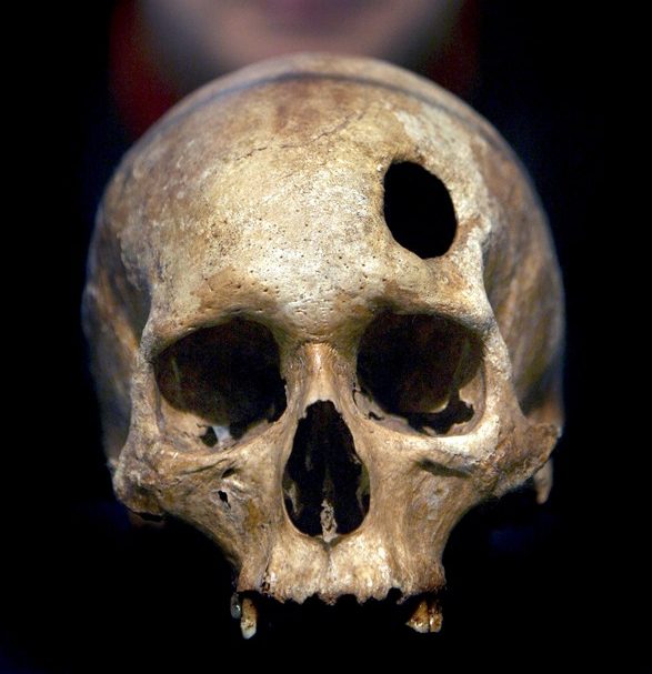 Fotografía de archivo de un cráneo con una trepanación frontal, como la encontrada por un equipo de arqueólogos en un esqueleto en Oriente Próximo.