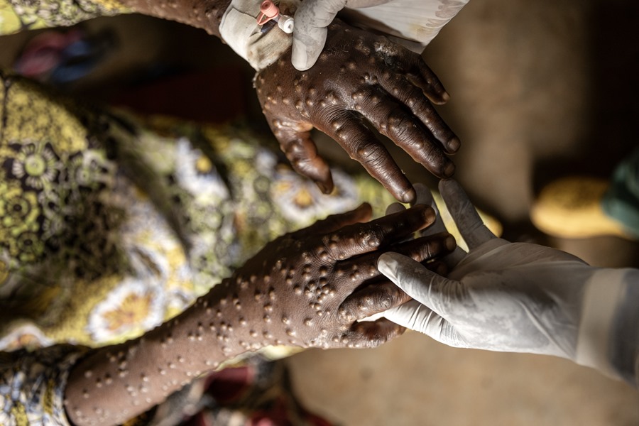 Africa has reported more than 42,300 cases and 1,100 deaths from mpox.